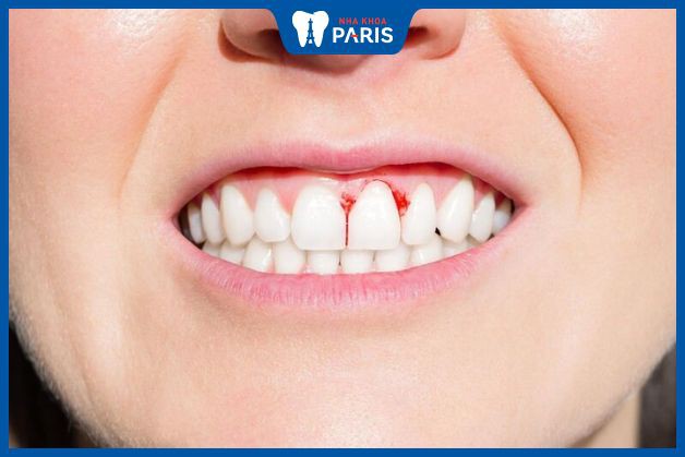 Bọc răng sứ bị viêm lợi: Nguyên nhân, dấu hiệu và cách điều trị